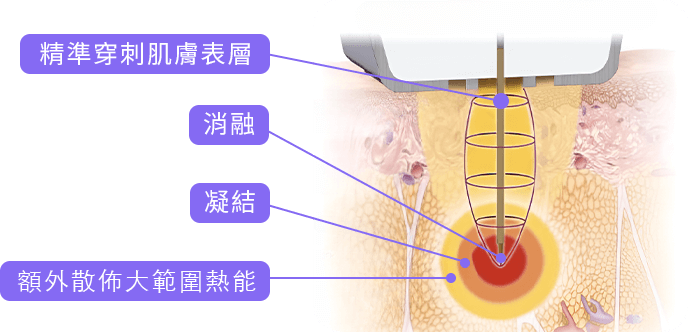 穿刺深度示意圖